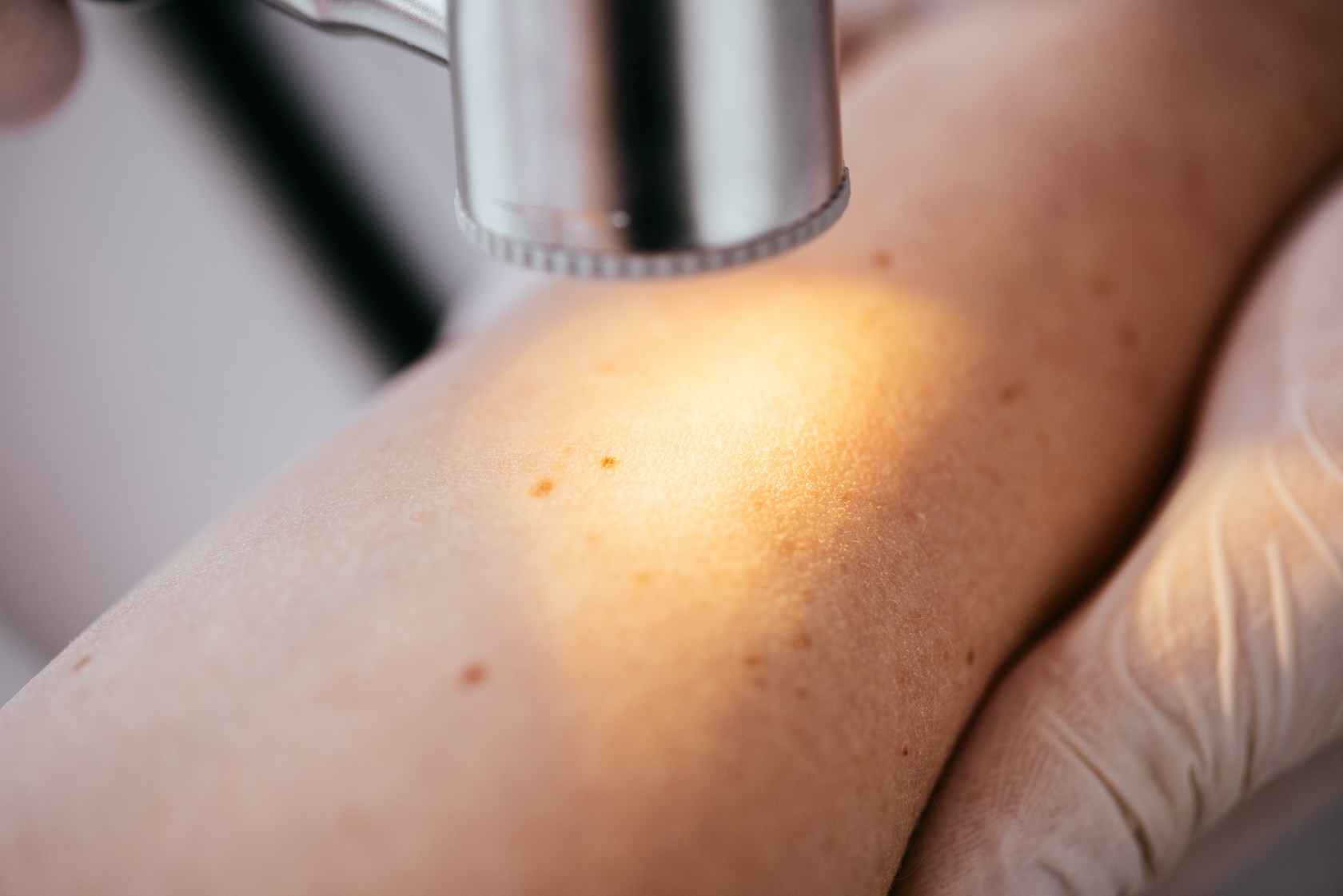 Pearly Penile Papules (PPP) Treatment at Glove Clinic